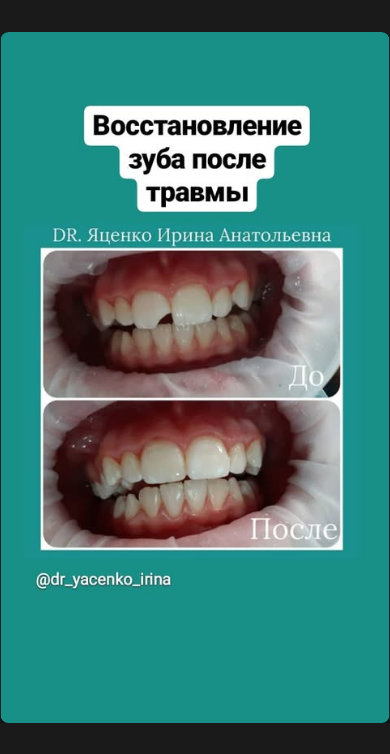 Восстановление зубов после травмы