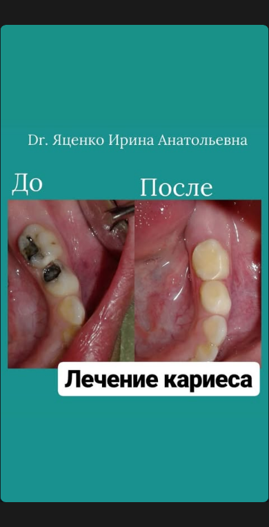 Лечение кариеса молочных зубов