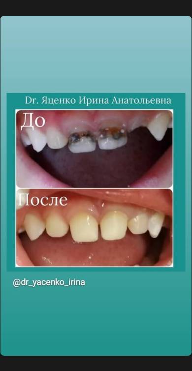 До и после передних зубов