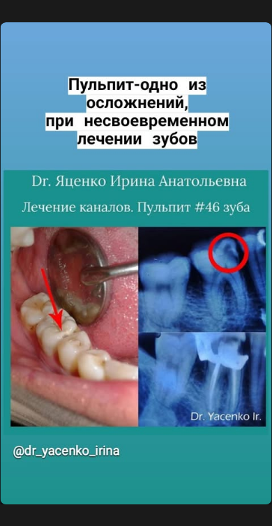 Эндодонтия — лечение каналов
