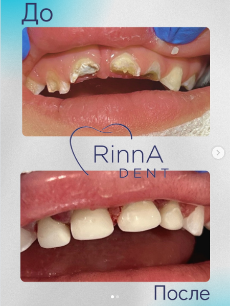 До и после лечения в наркозе