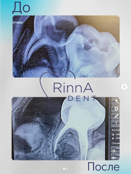 Удаление молочных зубов