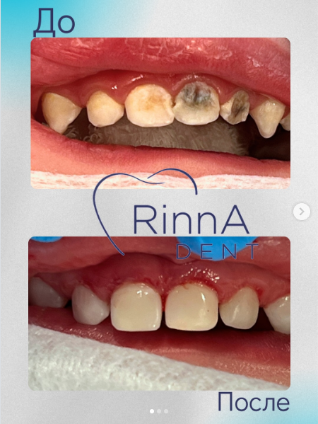 До и после лечения передних зубов