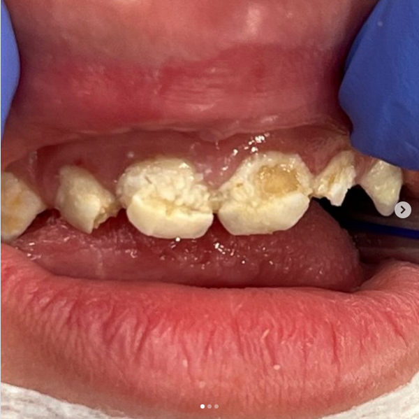 До/После/Спустя год — результаты RinnaDent