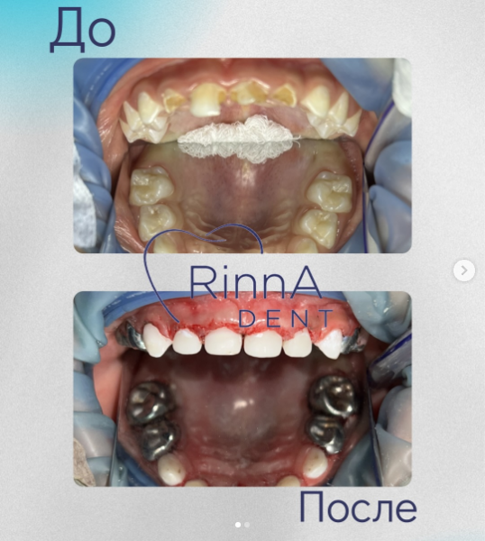 До и после лечения молочных зубов RinnaDent